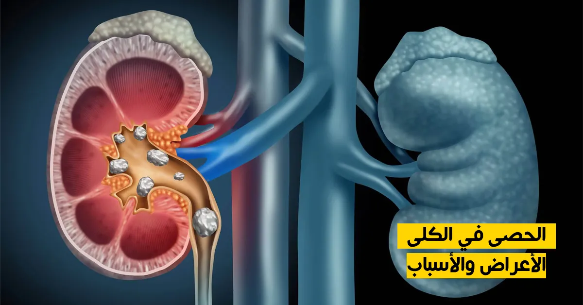 الحصى في الكلى : الأعراض والأسباب